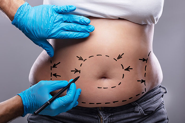 abdominoplastie