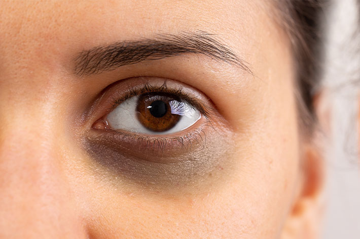 Blépharoplastie