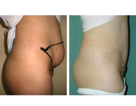 Résultat Abdominoplastie Avant / Après - Patiente 1