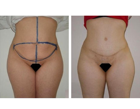 Résultat Abdominoplastie Avant / Après - Patiente 2