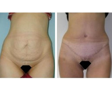 Résultat Abdominoplastie Avant / Après - Patiente 3