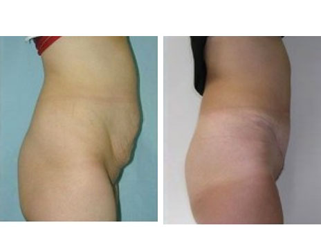 Résultat Abdominoplastie Avant / Après - Patiente 3