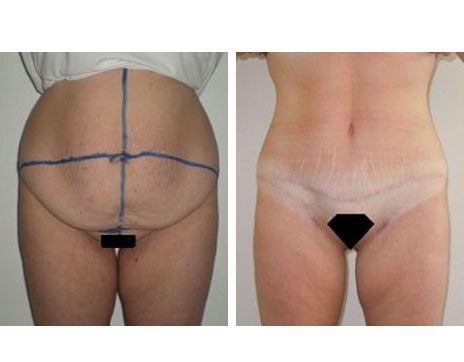 Résultat Abdominoplastie Avant / Après - Patiente 4