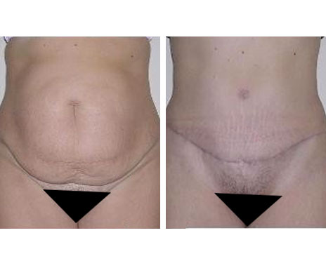 Résultat Abdominoplastie Avant / Après - Patiente 5