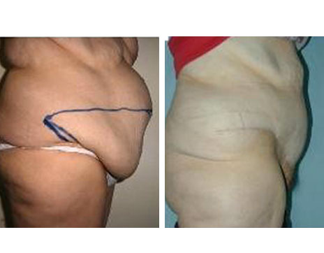 Résultat Abdominoplastie Avant / Après - Patiente 6