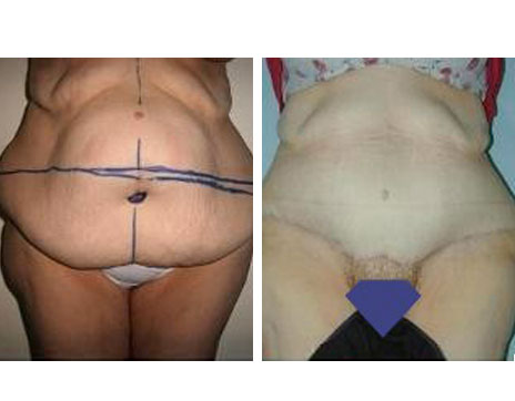 Résultat Abdominoplastie Avant / Après - Patiente 6