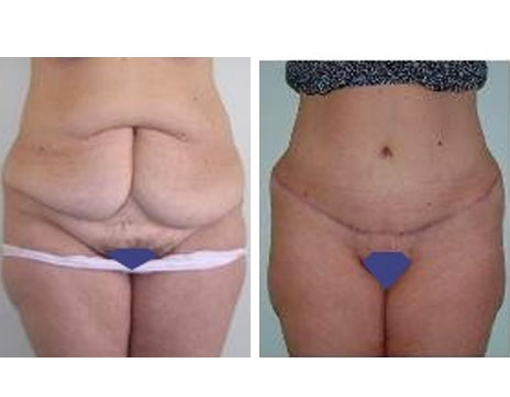 Résultat Abdominoplastie Avant / Après - Patiente 7