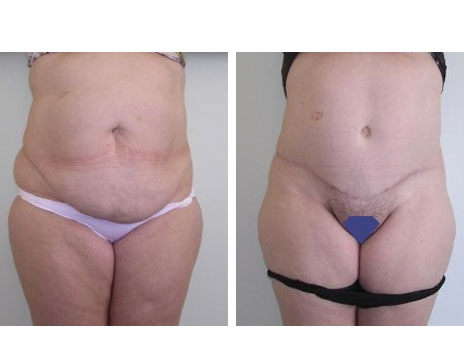 Résultat Abdominoplastie Avant / Après - Patiente 9