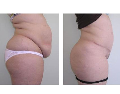 Résultat Abdominoplastie Avant / Après - Patiente 9-2