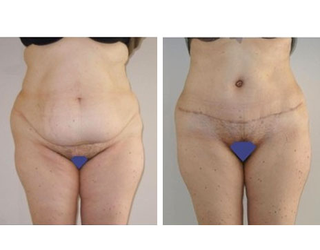 Résultat Abdominoplastie Avant / Après - Patiente 11