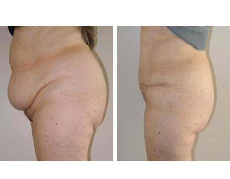 Résultat Abdominoplastie Avant / Après - Patiente 11-2