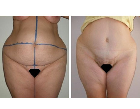 Résultat Abdominoplastie Avant / Après - Patiente 12