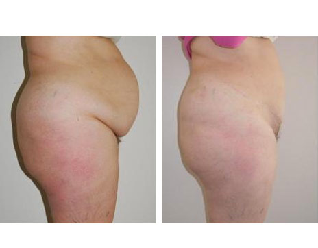 Résultat Abdominoplastie Avant / Après - Patiente 12-2