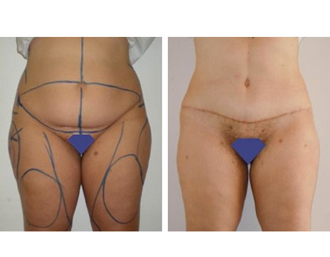 Résultat Abdominoplastie Avant / Après - Patiente 13