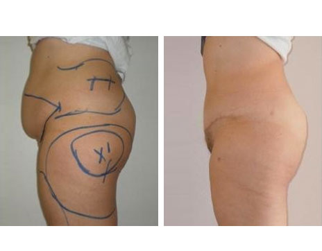 Résultat Abdominoplastie Avant / Après - Patiente 13-2