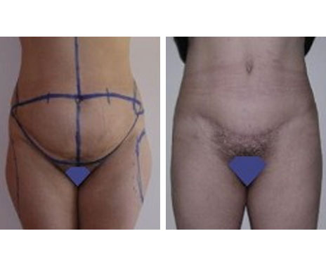 Résultat Abdominoplastie Avant / Après - Patiente 14