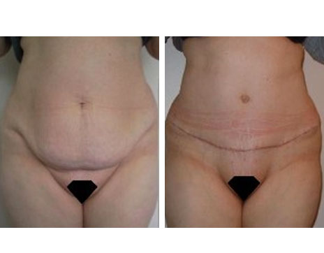 Résultat Abdominoplastie Avant / Après - Patiente 15