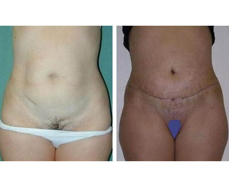 Résultat Abdominoplastie Avant / Après - Patiente 19