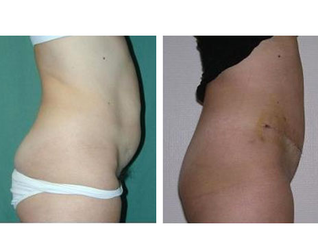 Résultat Abdominoplastie Avant / Après - Patiente 19-2