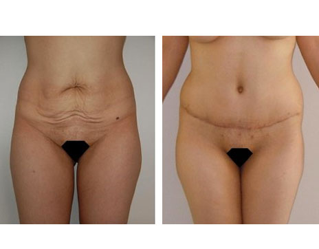 Résultat Abdominoplastie Avant / Après - Patiente 20