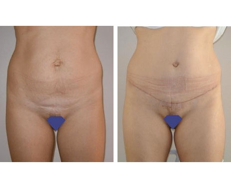 Résultat Abdominoplastie Avant / Après - Patiente 21