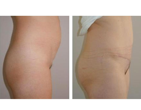 Résultat Abdominoplastie Avant / Après - Patiente 21-2