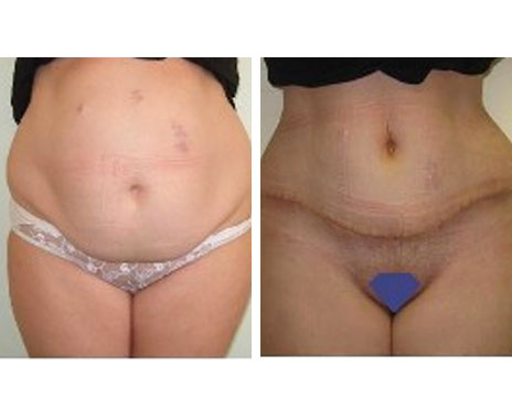 Résultat Abdominoplastie Avant / Après - Patiente 22