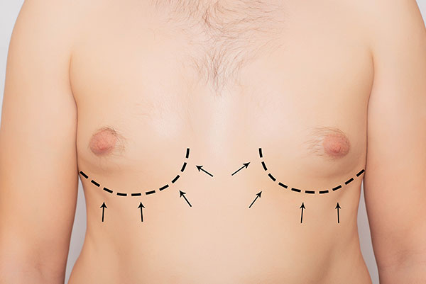 gynecomastie solution